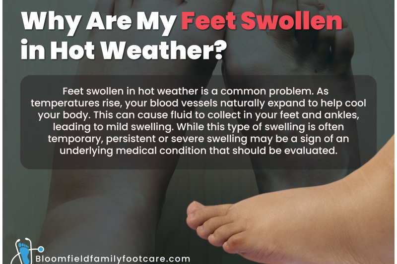 Swollen Foot in Hot Weather